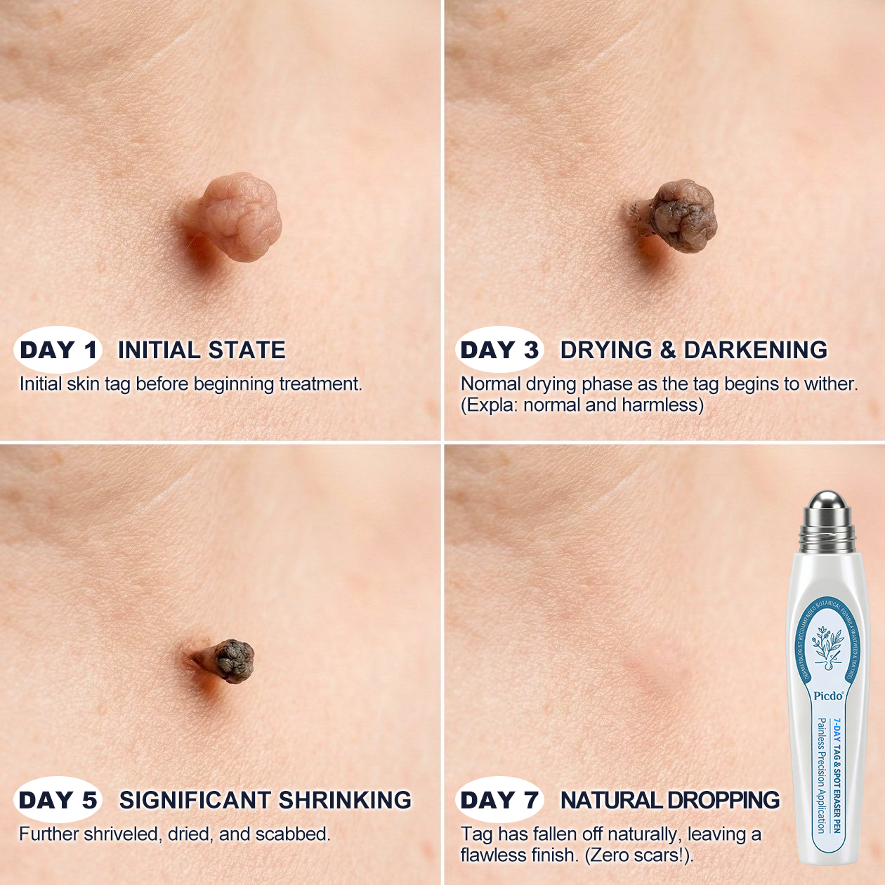 𝐎𝐟𝐟𝐢𝐜𝐢𝐚𝐥 𝐁𝐫𝐚𝐧𝐝 𝐒𝐭𝐨𝐫𝐞 |✅50%𝐏i𝐜𝐝o® 7-𝐷𝑎𝑦 𝗧𝐚𝐠 & 𝗦𝗽𝐨𝐭 𝐄𝐫𝒂𝒔𝒆𝒓(Zero Pain, Zero 𝐒𝐜𝐚𝒓𝒔 Rollerball)