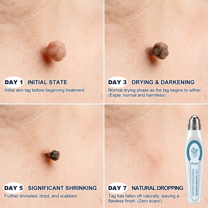 𝐎𝐟𝐟𝐢𝐜𝐢𝐚𝐥 𝐁𝐫𝐚𝐧𝐝 𝐒𝐭𝐨𝐫𝐞 |✅𝐏i𝐜𝐝o® 7-𝐷𝑎𝑦 𝗧𝐚𝐠 & 𝗦𝗽𝐨𝐭 𝐄𝐫𝒂𝒔𝒆𝒓(Zero Pain, Zero 𝐒𝐜𝐚𝒓𝒔 Rollerball)🔥